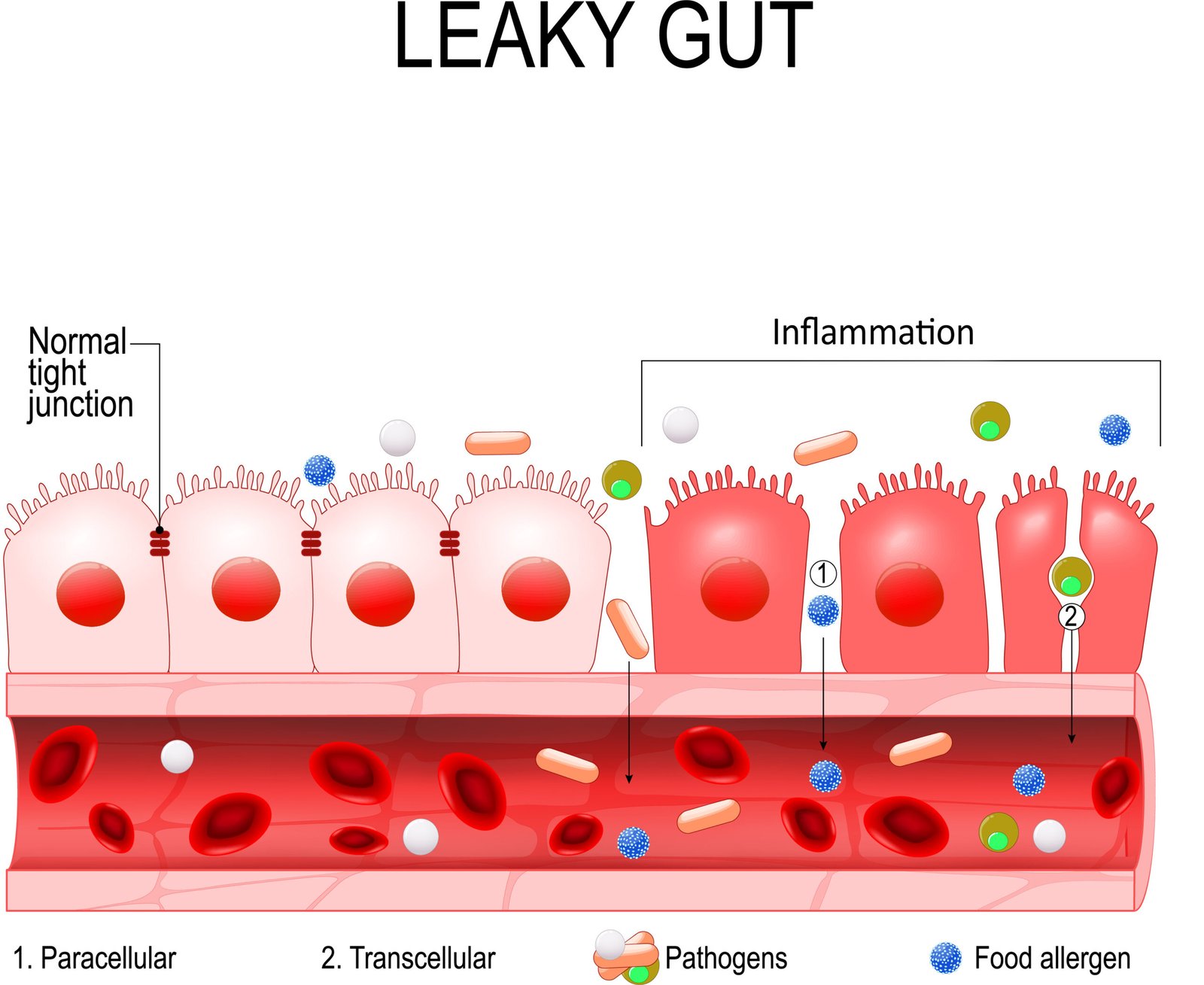 What is Leaky Gut?